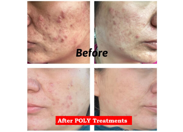 Before and after results of acne treatment with POLY Pro Clear BlueLight therapy.