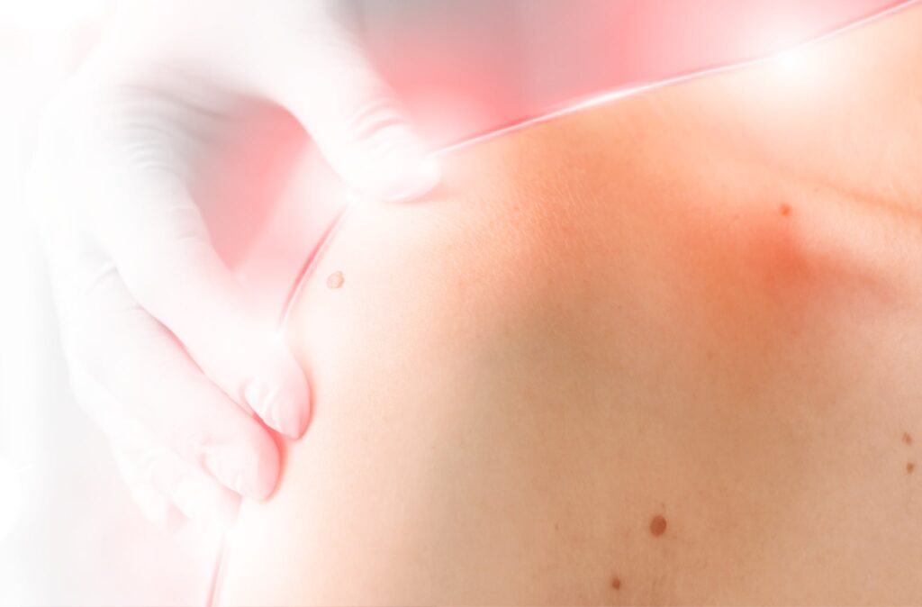 Close-up of gloved hand examining a woman's shoulder skin for light therapy treatment